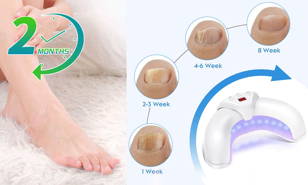 Welnax BioClear Toenail Fungus Device Result