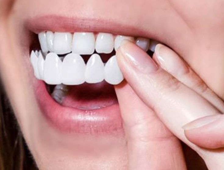 Shiny Smile Veneers reviews 1