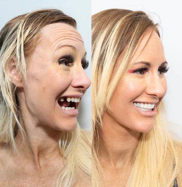 Shiny Smile Veneers reviews 3