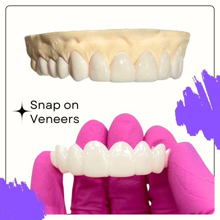 Shiny Smile Veneers reviews 4