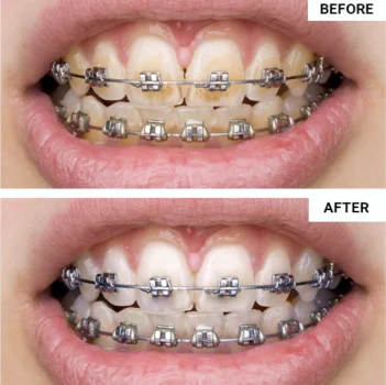 WellaWhite Water Flosser Reviews5