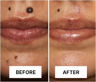 NutriDermaGuard Skin Tag Remover Reviews3