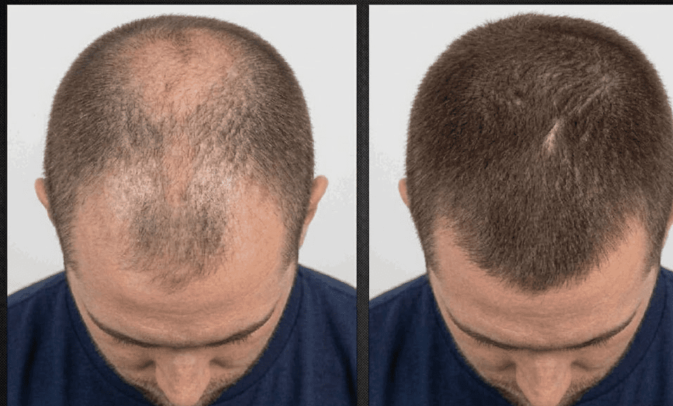 HaloGrow Hair Spray for Men Reviews
