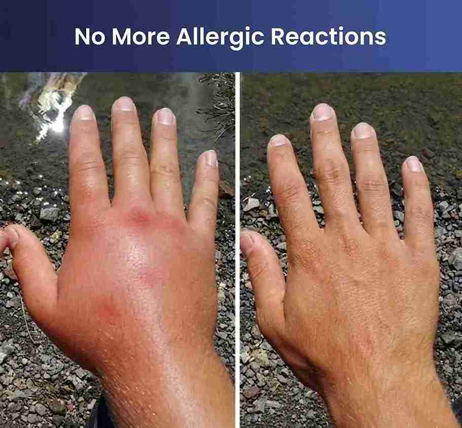 Insect Bite Relief Reviews
