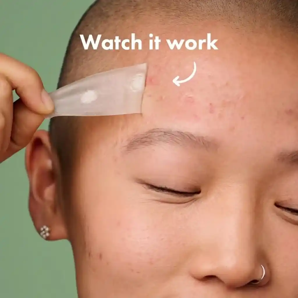 Mighty Patch original acne spot treatment