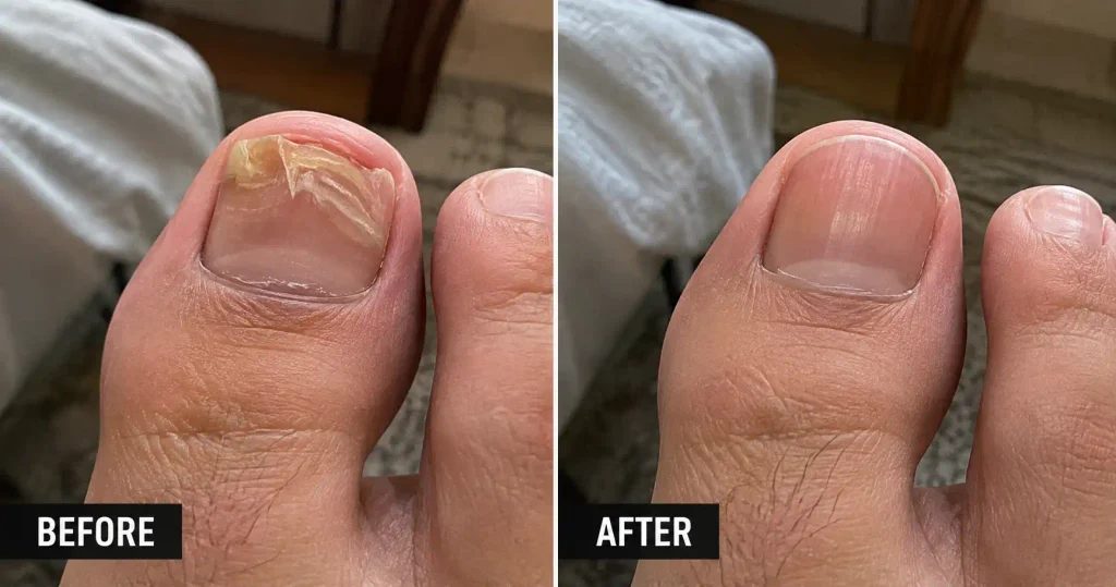 kerasal nail repair solution before after