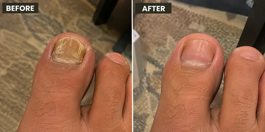 foliaya fungus pen before after